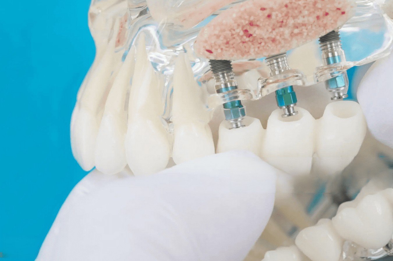 Confronto tra Galileus Cerclage Sinus® e All-on-4: due tecniche per l’implantologia dentale completa